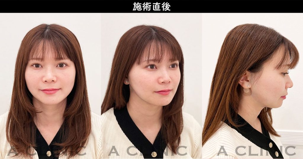 顔の脂肪吸引のダウンタイム経過 施術直後