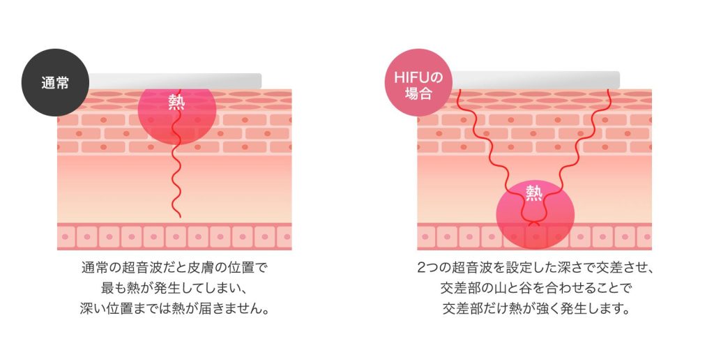 HIFUについて