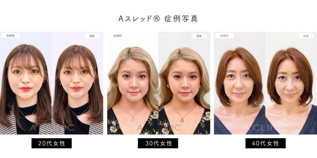 Aスレッド®症例写真