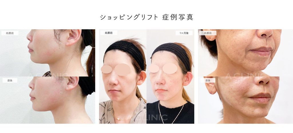 ショッピングリフト症例写真