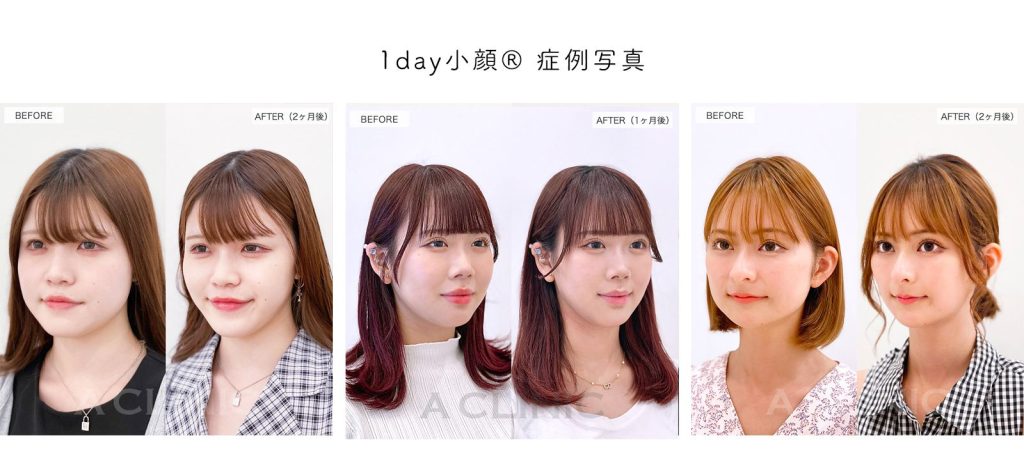 1day小顔®症例写真