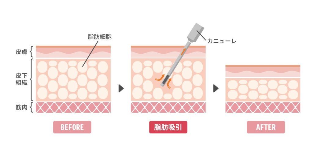 カニューレと呼ばれる細い管を用いて皮膚の下の皮下脂肪を吸引
