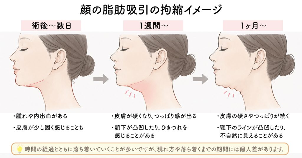 顔の脂肪吸引