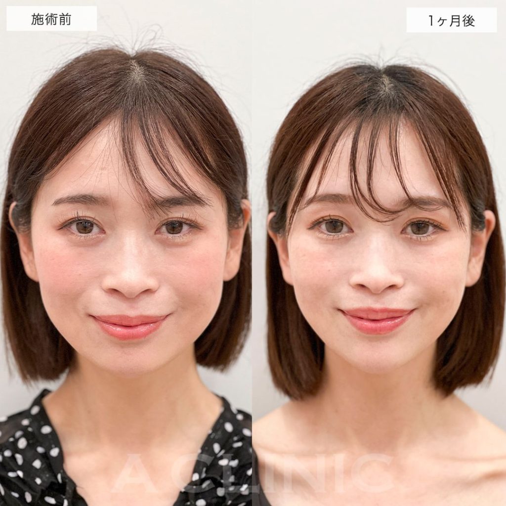 A式たるみ切開®︎