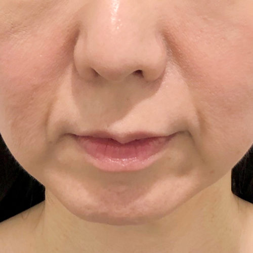 ヒアルロン酸注射でほうれい線のしわを改善 ほうれい線へのヒアルロン酸注入の症例です 40代女性 美容整形のa Clinic 美容外科 美容皮膚科 形成外科