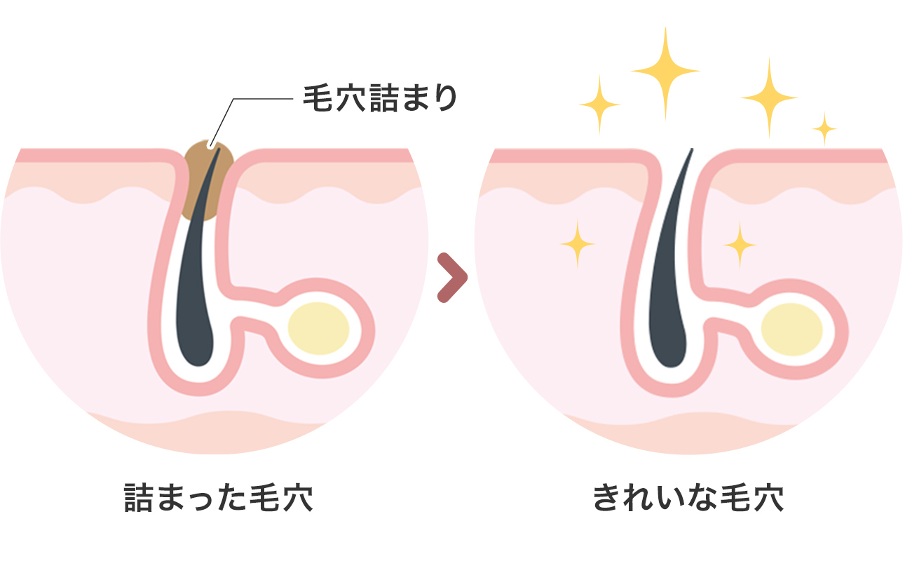 ニキビの原因となる毛穴の詰まりの解消