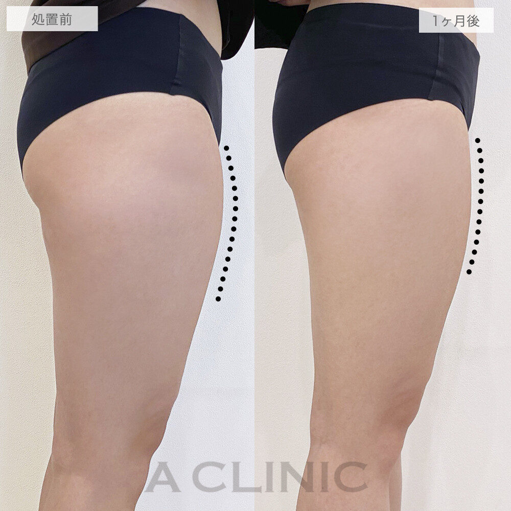 ボトックス注射の症例写真