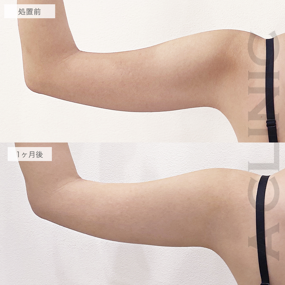 ボトックス注射の症例写真