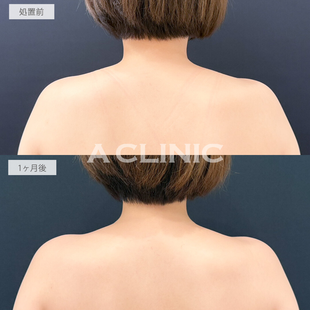 ボトックス注射の症例写真