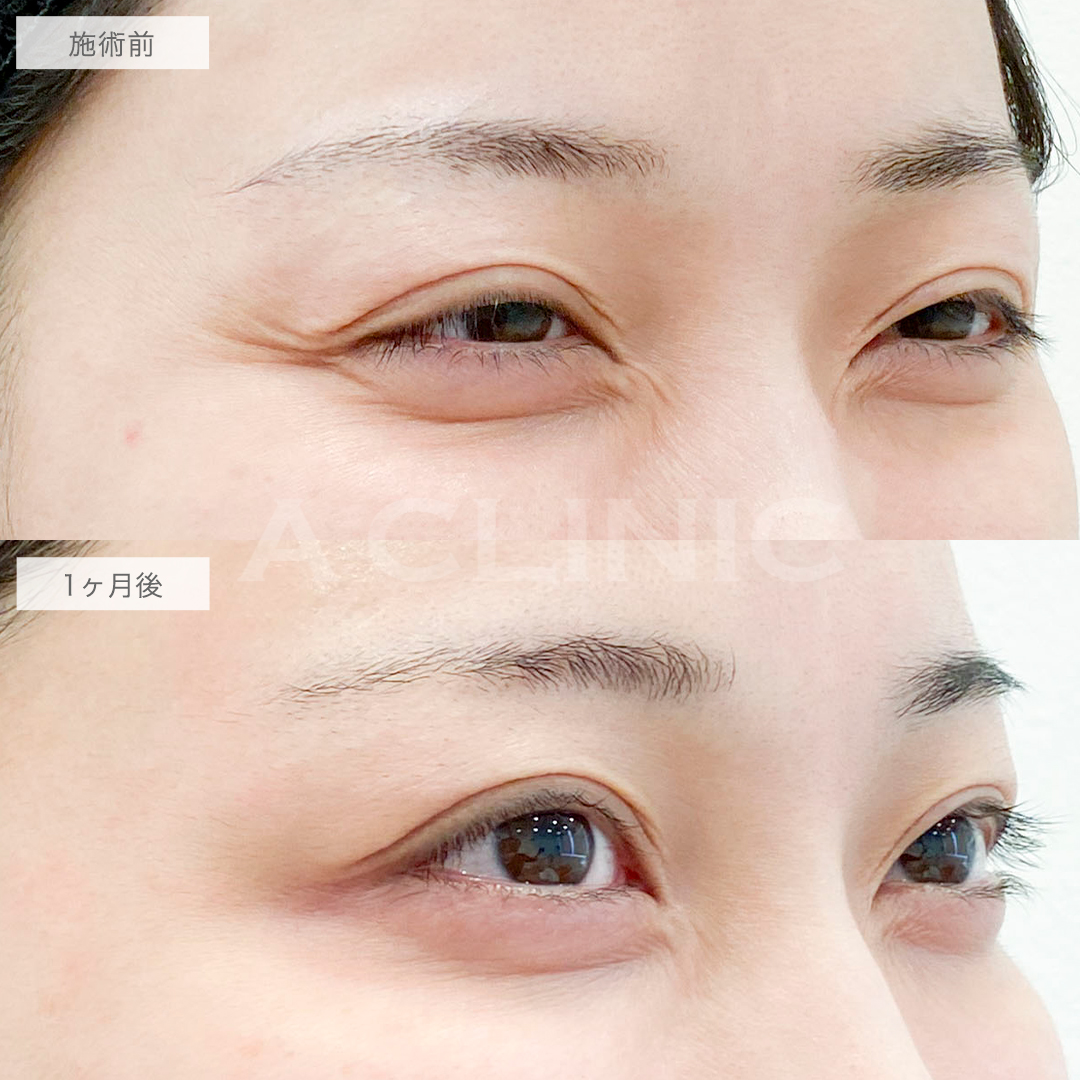 ボトックス注射の症例写真