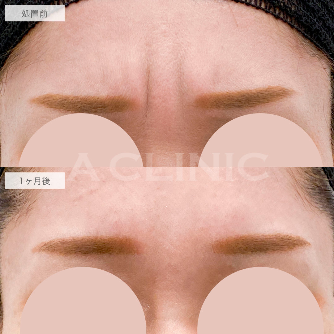 ボトックス注射の症例写真