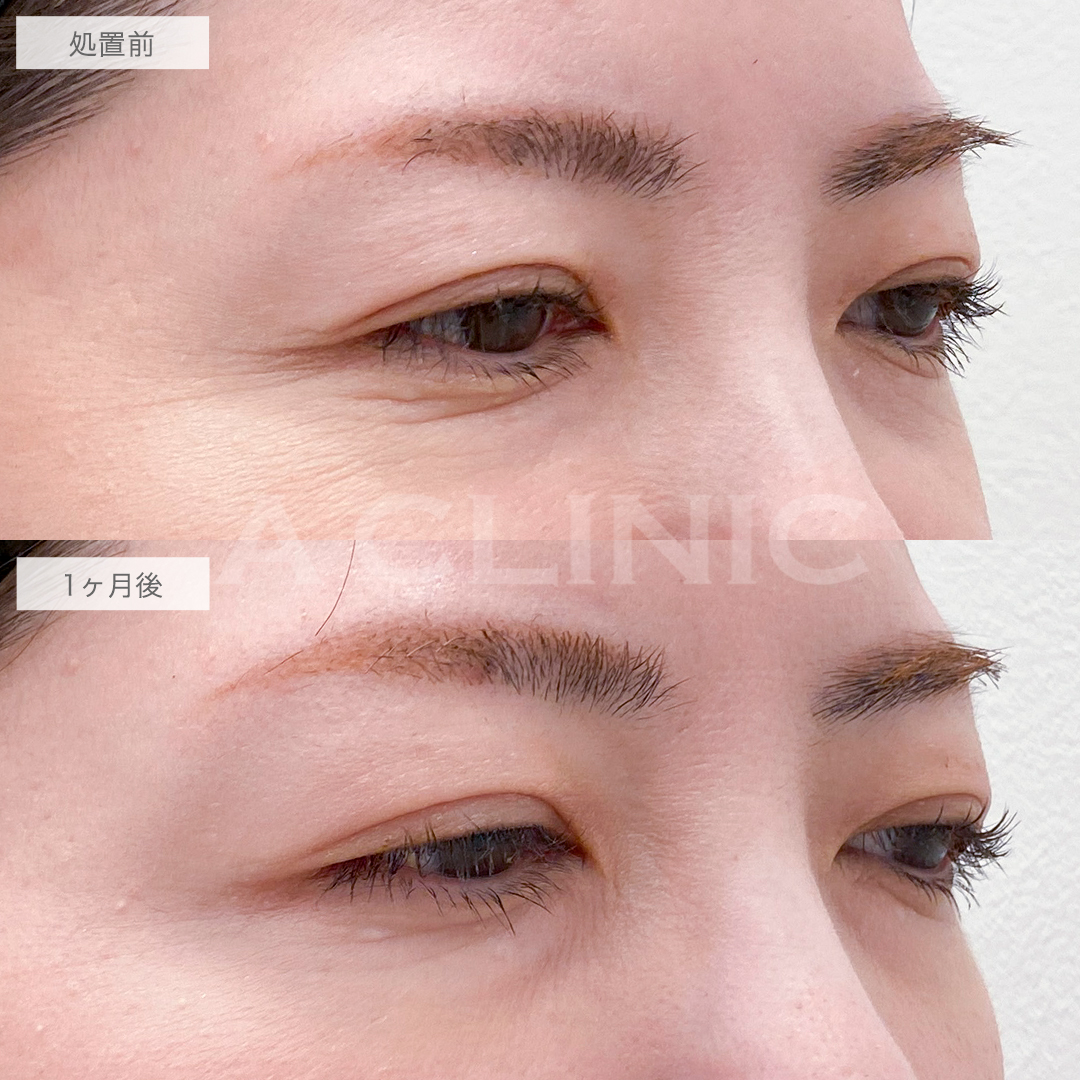 ボトックス注射の症例写真