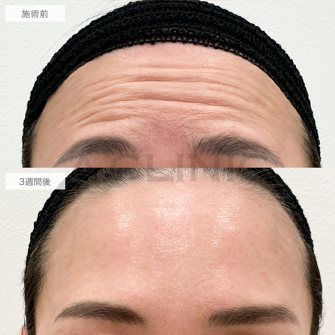 ボトックス注射の症例写真