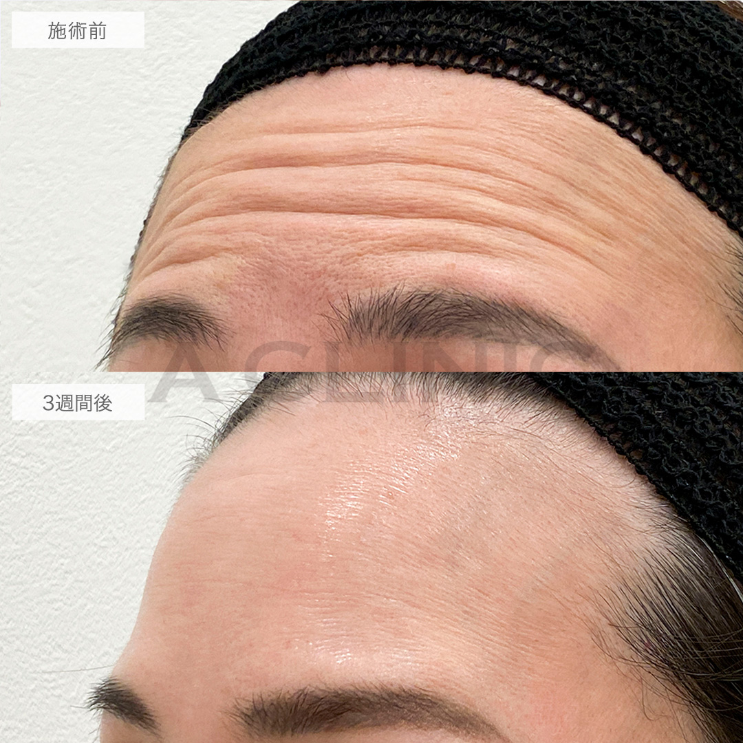 ボトックス注射の症例写真