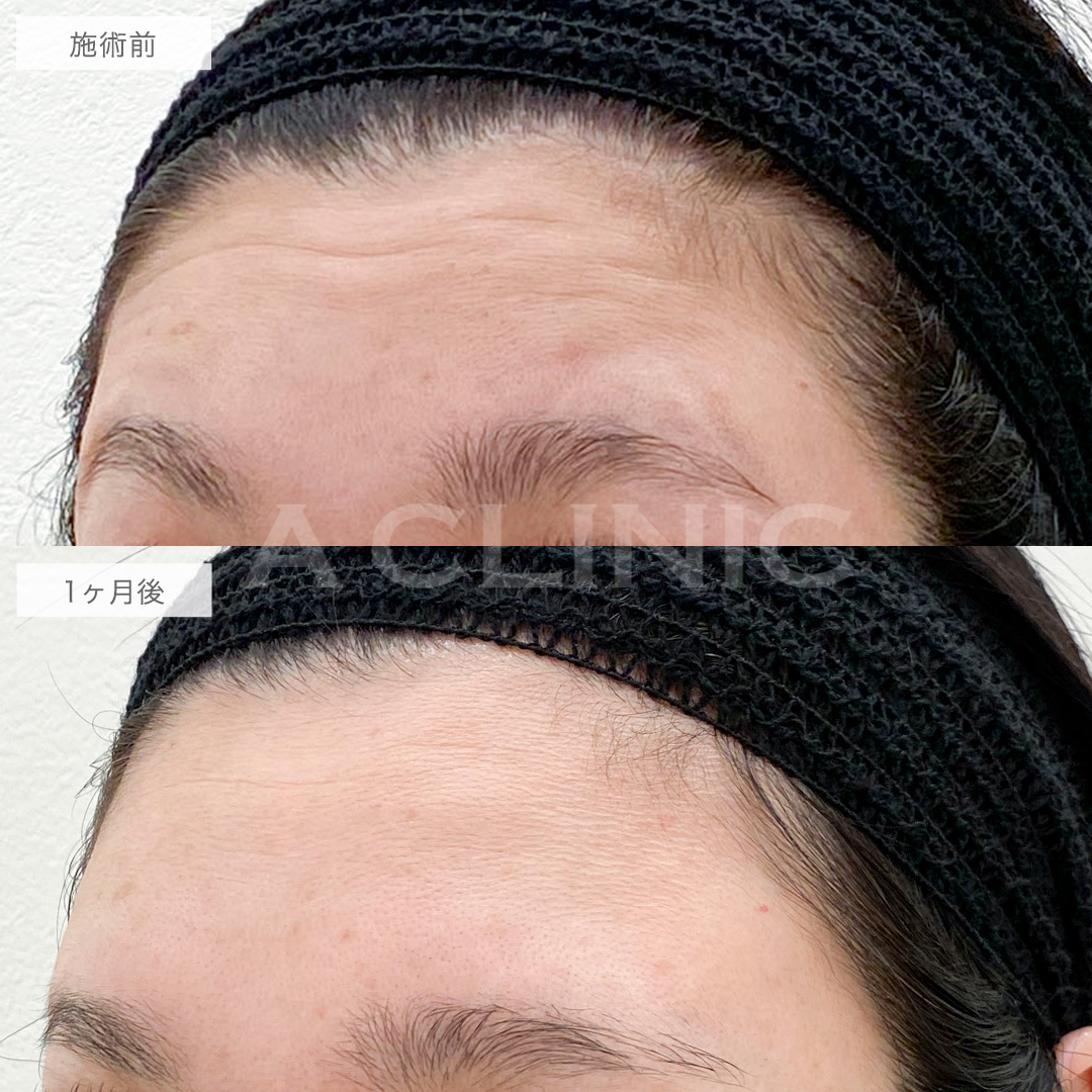 ボトックス注射の症例写真