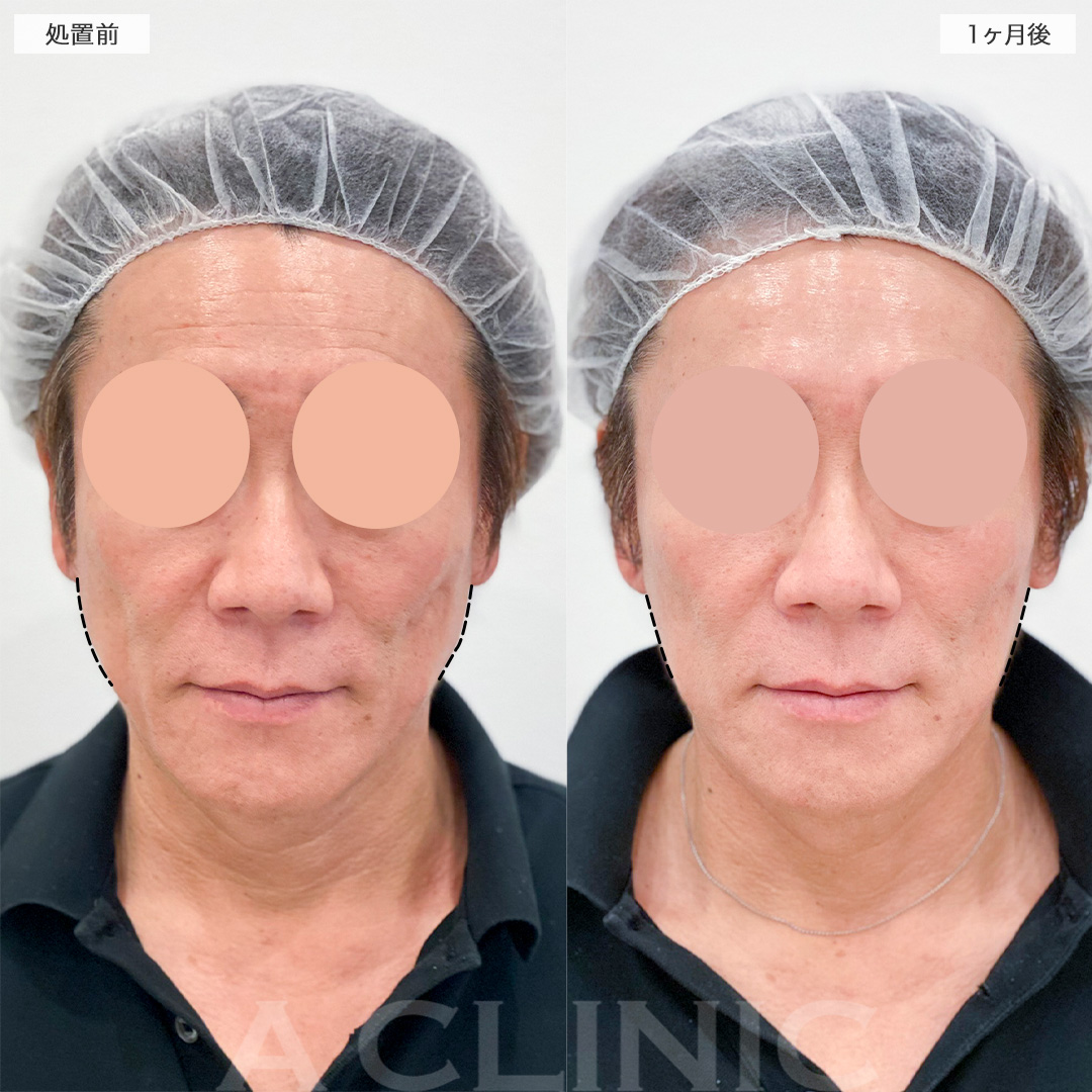 ボトックス注射の症例写真