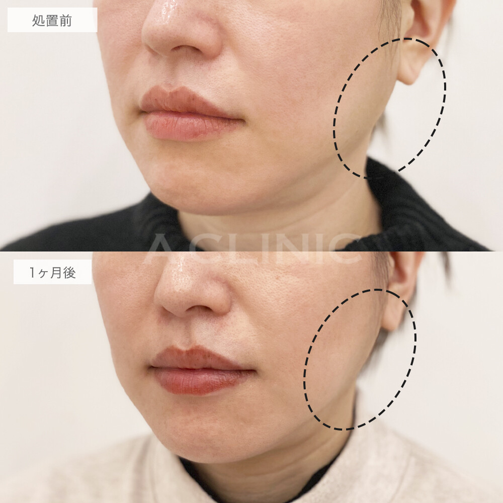 ボトックス注射の症例写真