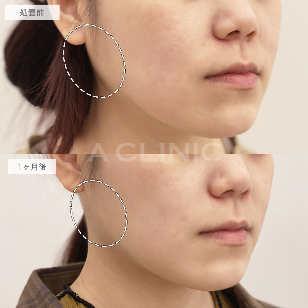 ボトックス注射の症例写真