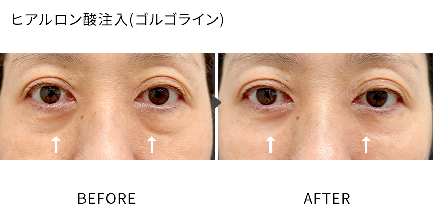 症例写真　ヒアルロン酸注入（ゴルゴライン）