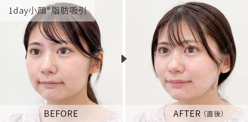 症例写真 1day小顔脂肪吸引