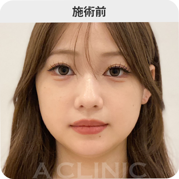 1day小顔®︎ダウンタイムの症例写真