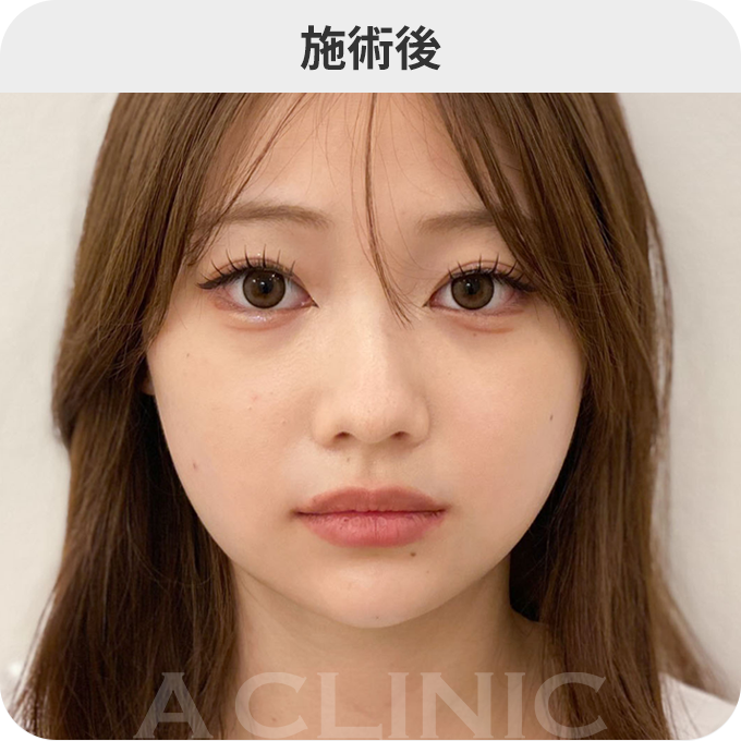 1day小顔®︎ダウンタイムの症例写真