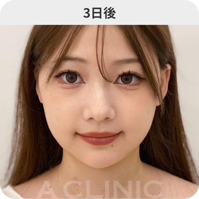 1day小顔®︎ダウンタイムの症例写真