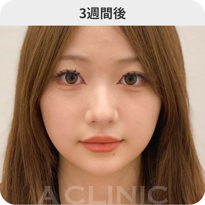 1day小顔®︎ダウンタイムの症例写真