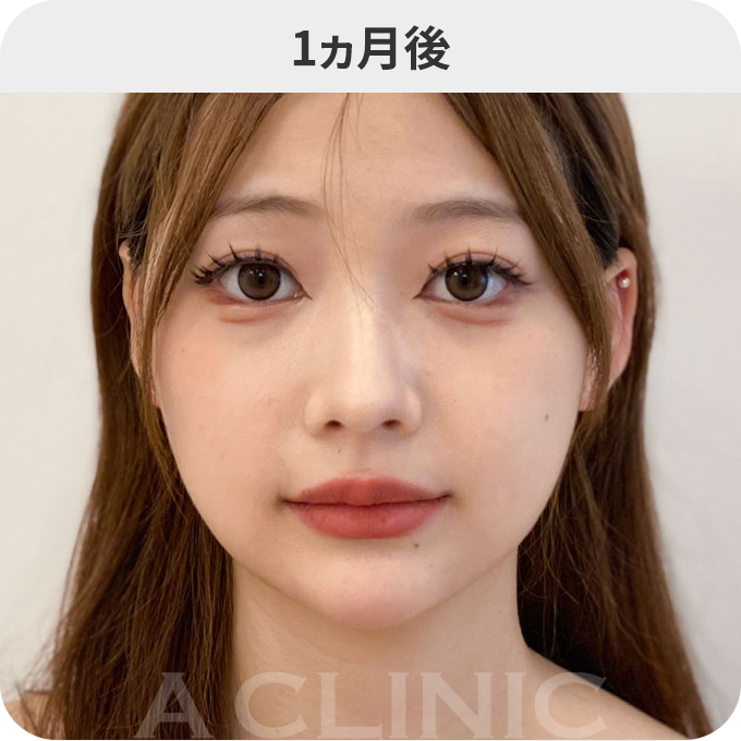 1day小顔®︎ダウンタイムの症例写真