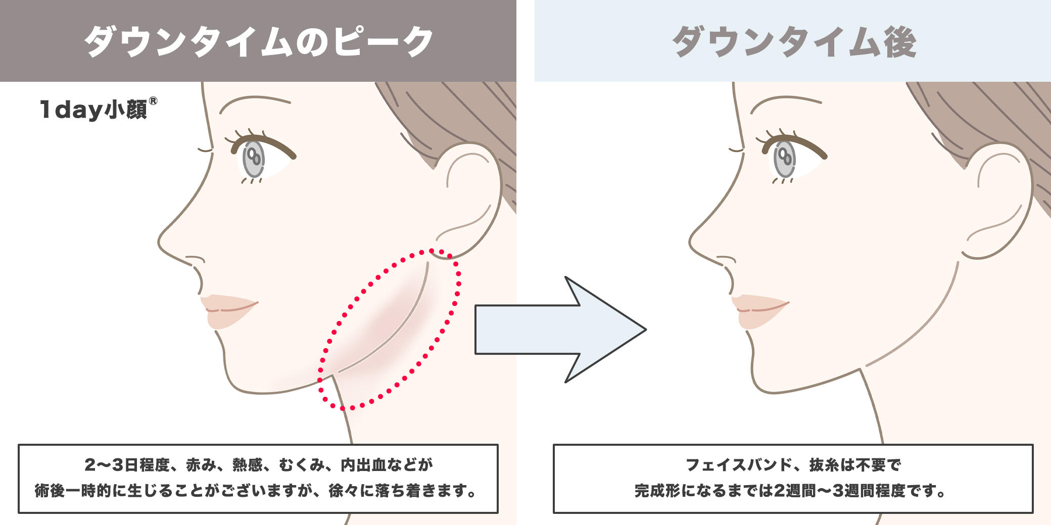 1day小顔®のダウンタイムイラスト
