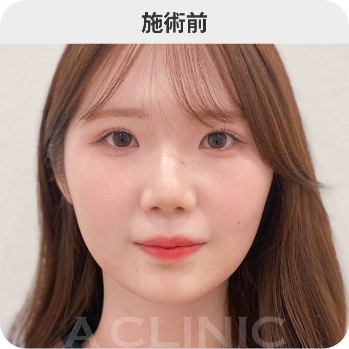 Aスレッド®ダウンタイムの症例写真