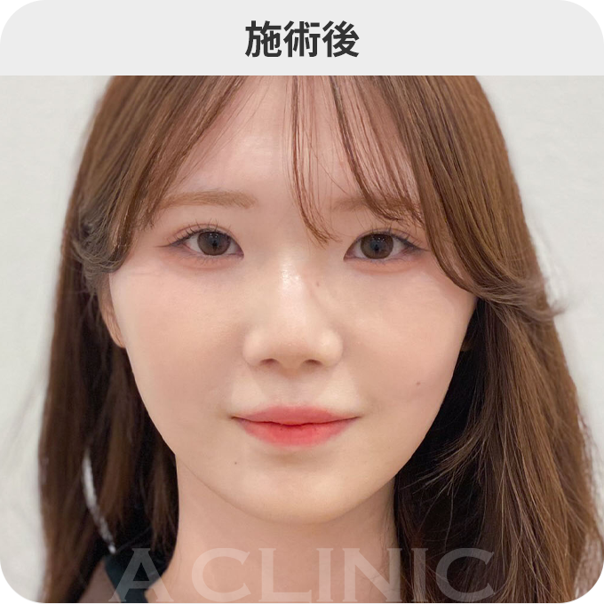 Aスレッド®ダウンタイムの症例写真