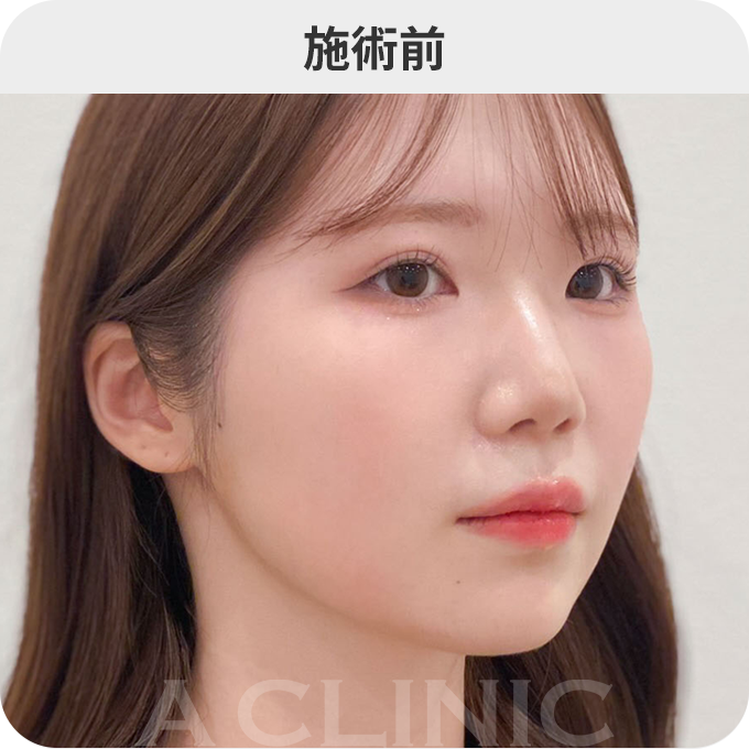 Aスレッド®ダウンタイムの症例写真