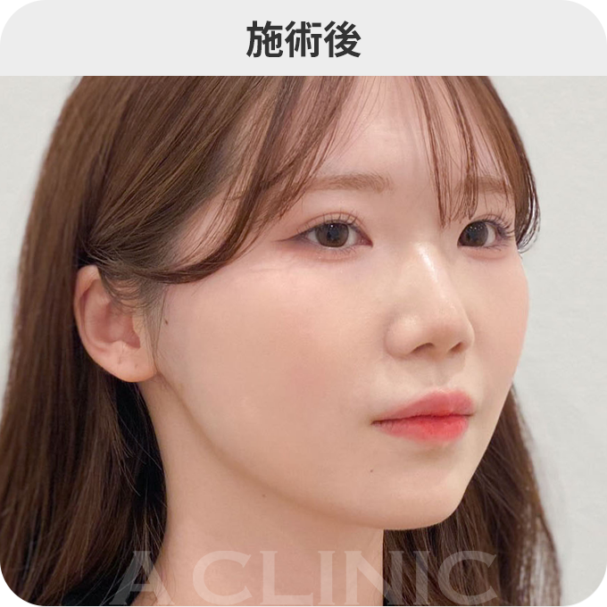 Aスレッド®ダウンタイムの症例写真