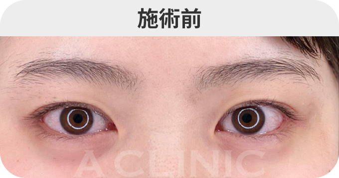 眉下リフトダウンタイムの症例写真