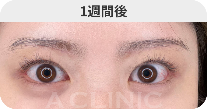 眉下リフトダウンタイムの症例写真