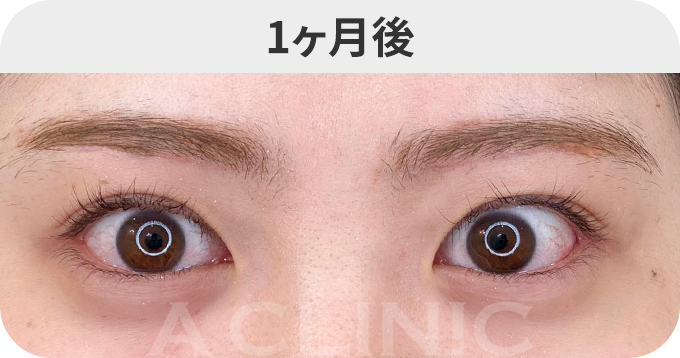 眉下リフトダウンタイムの症例写真