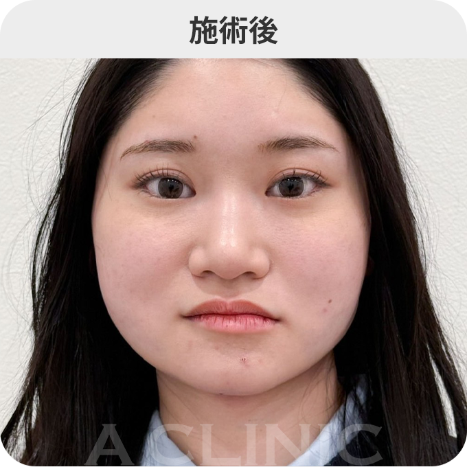 バッカルファット除去術ダウンタイムの症例写真