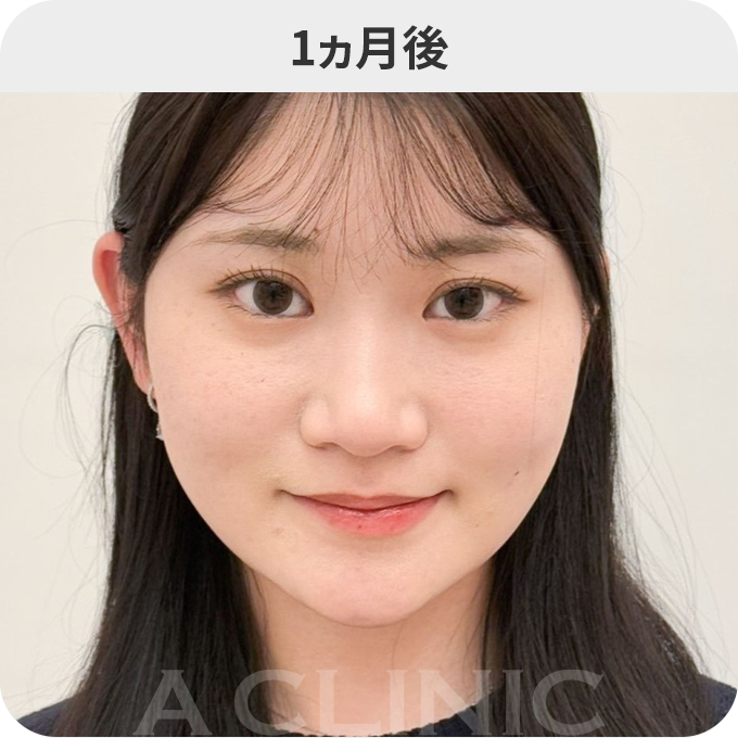 バッカルファット除去術ダウンタイムの症例写真