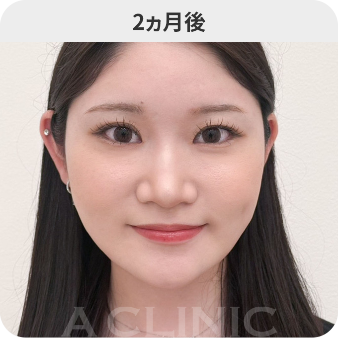 バッカルファット除去術ダウンタイムの症例写真