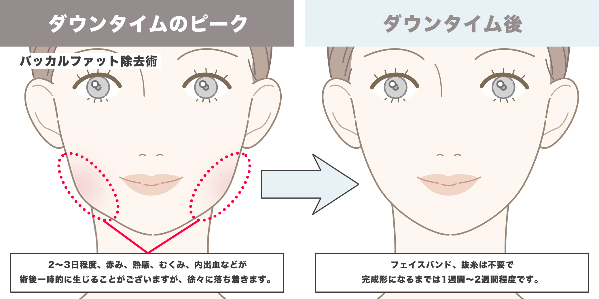 バッカルファット除去術のダウンタイムイラスト