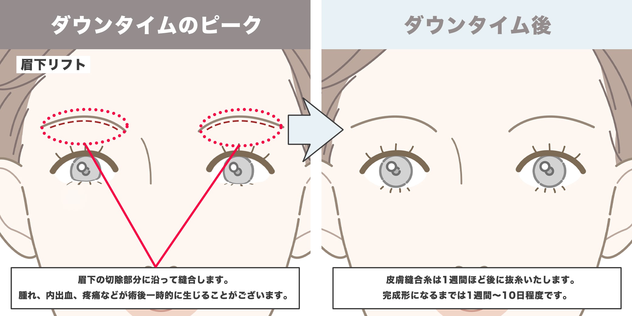 眉下リフトのダウンタイムイラスト
