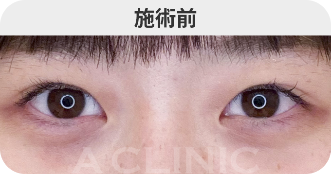 二重術埋没法ダウンタイムの症例写真