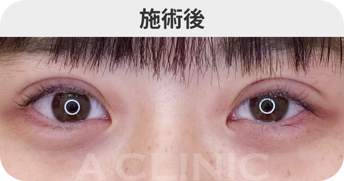 二重術埋没法ダウンタイムの症例写真