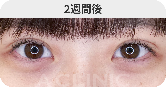 二重術埋没法ダウンタイムの症例写真