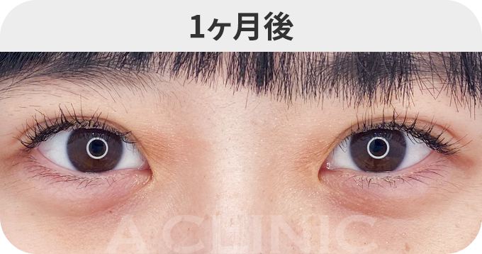 二重術埋没法ダウンタイムの症例写真
