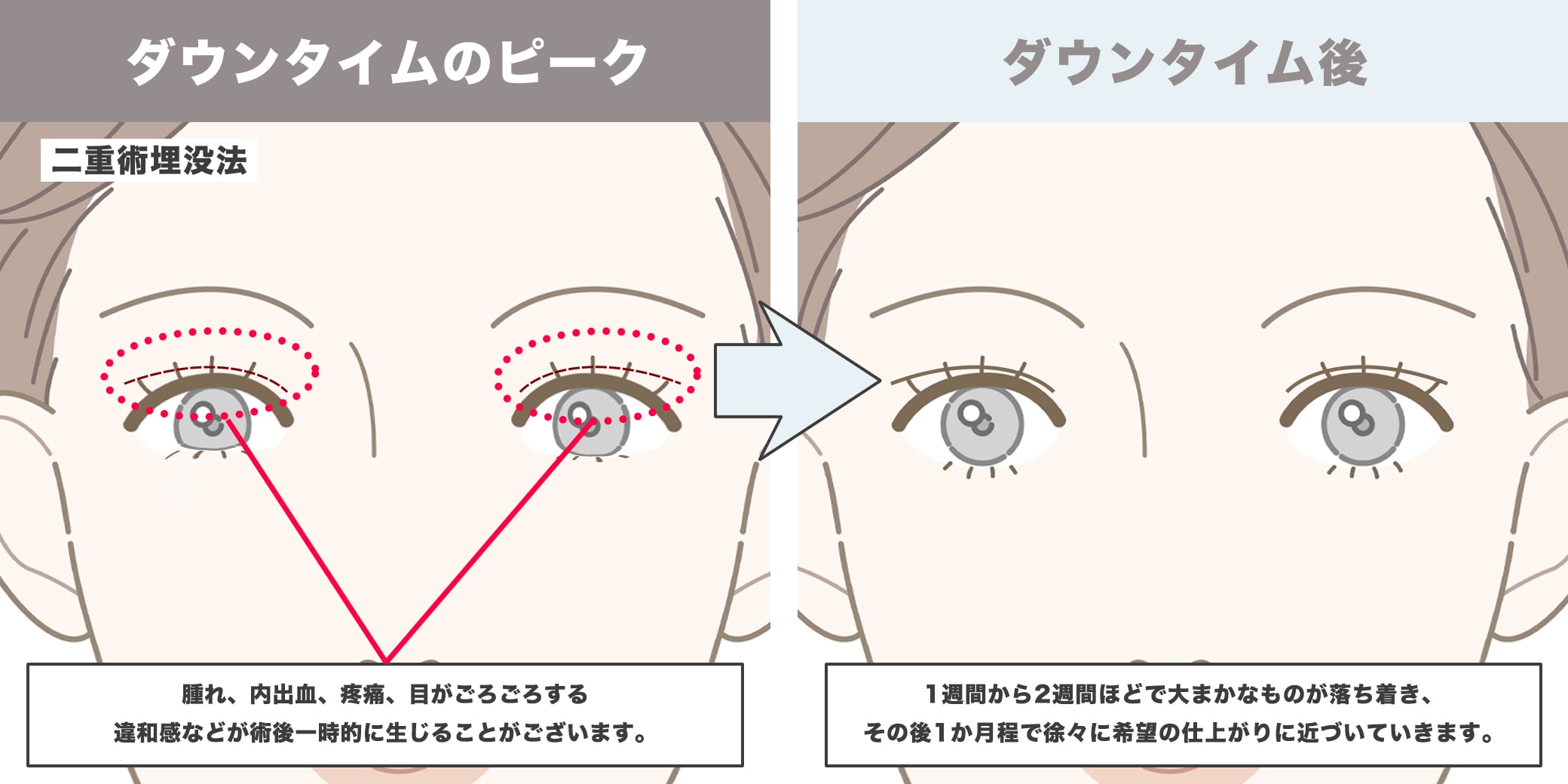 二重術埋没法のダウンタイムイラスト