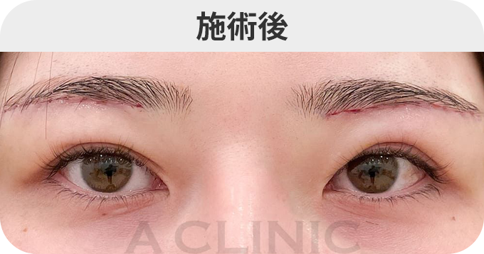 ダウンタイムの症例写真