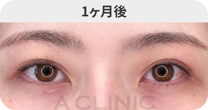 ダウンタイムの症例写真
