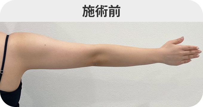 二の腕スリム脂肪吸引ダウンタイムの症例写真